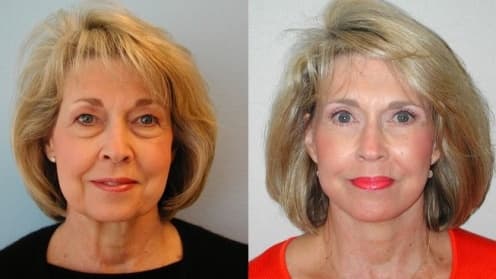 Facelift