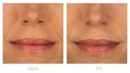 Botulinumtoxin
