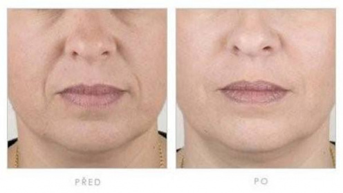 Botulinumtoxin