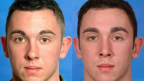 Rhinoplastik