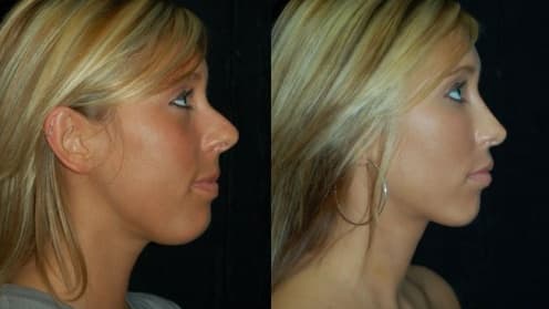 Rhinoplastik