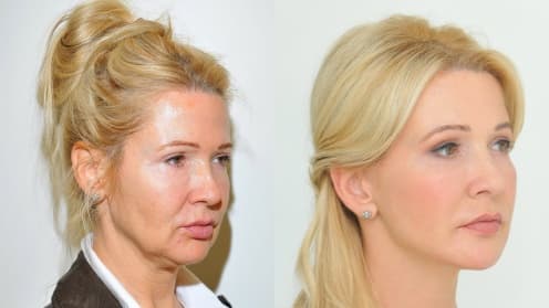 Facelift