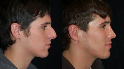 Rhinoplastik