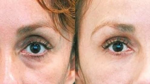 Augenringe und Tränensack