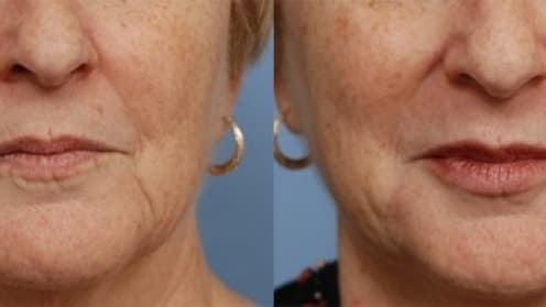 Botulinumtoxin