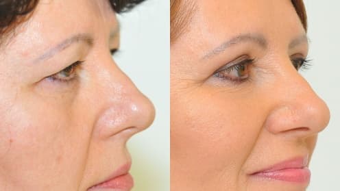Facelift