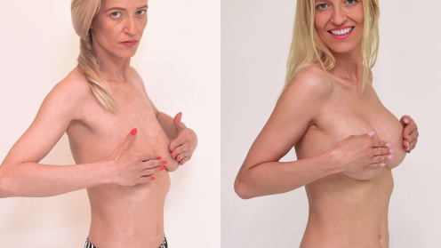 Brustmodellierung