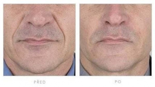 Botulinumtoxin