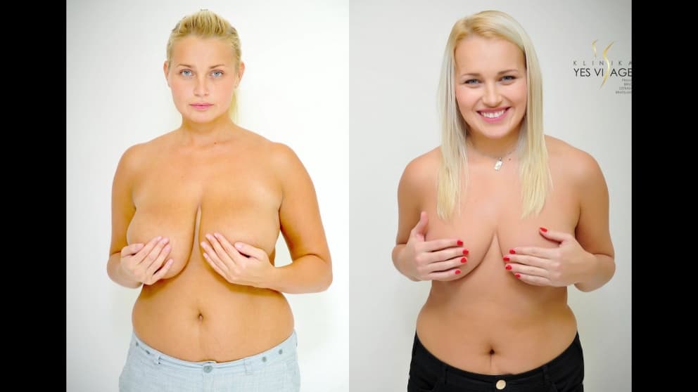 VIDEO PREMENA: Zmenšenie prsníkov