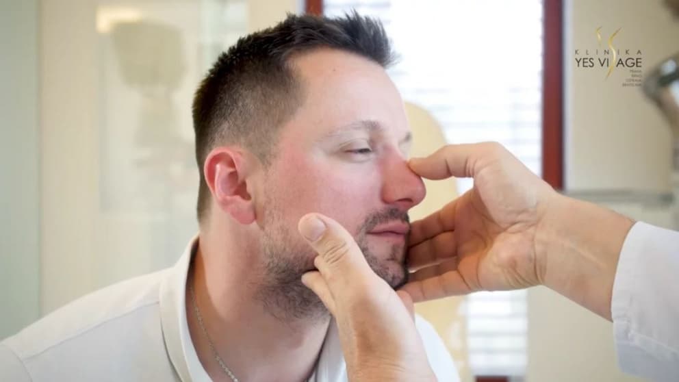 Rhinoplastika - Jakub