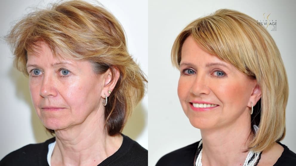 Facelift – Gesichtsverjüngung an der YES VISAGE-Klinik
