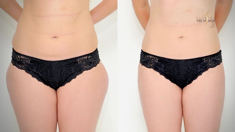 Lipotransfer - Prenos tuku na Klinike YES VISAGE