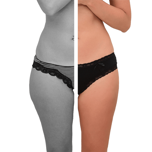 Laser-Fettabsaugung SlimLipo