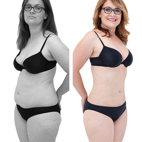 Laser-Fettabsaugung SlimLipo