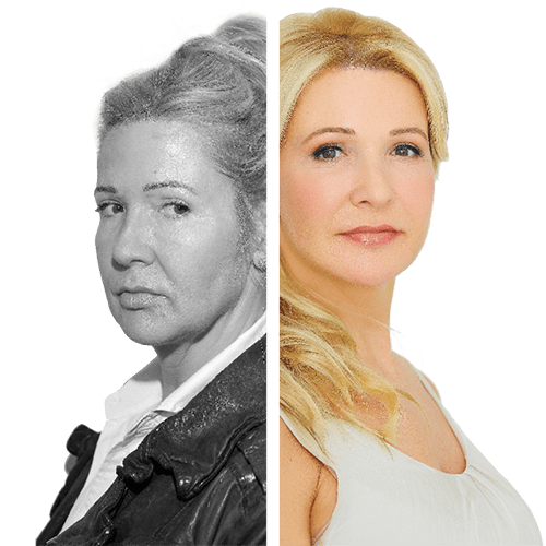 Fadenlifting, Facelift