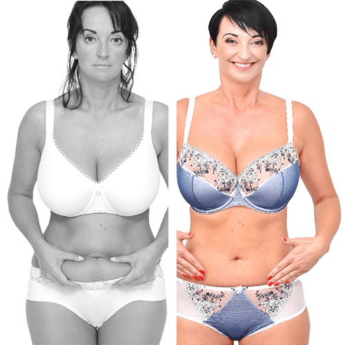 Laser-Fettabsaugung SlimLipo