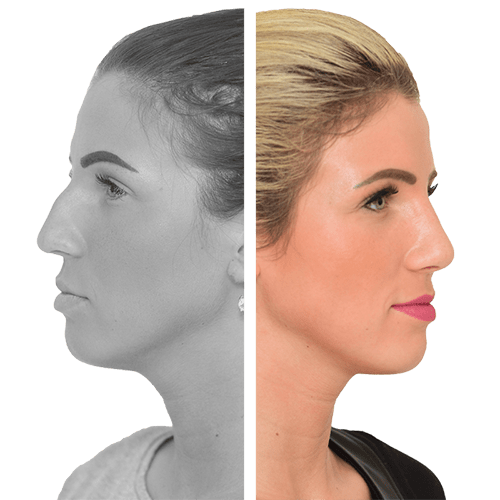 Rhinoplastik/Nasenkorrektur