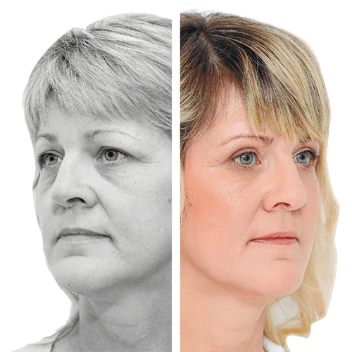 Augenliderkorrektur