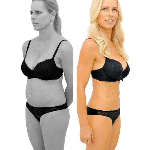 Laser-Fettabsaugung SlimLipo
