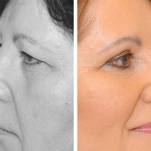 Facelift, Necklift, Augenliderkorrektur
