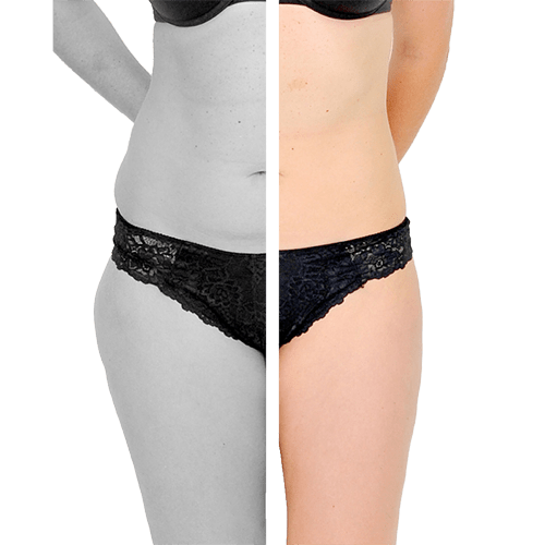 Laser-Fettabsaugung SlimLipo