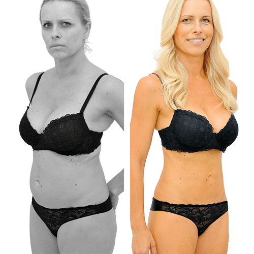 Laser-Fettabsaugung SlimLipo