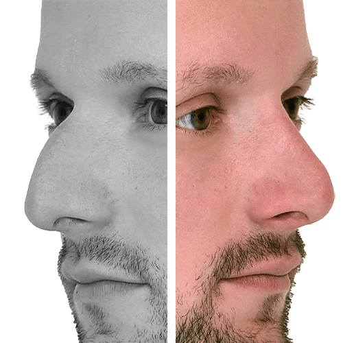 Rhinoplastik/Nasenkorrektur