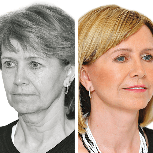 Facelift