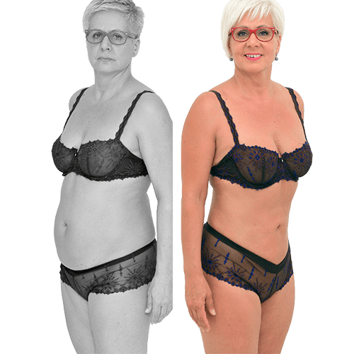 Laser-Fettabsaugung SlimLipo